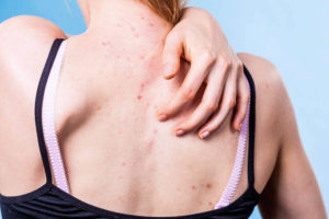 espinhas-nas-costas-dermatologia-brasilia